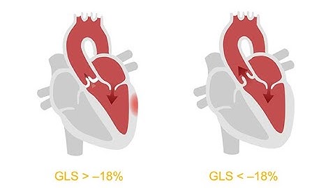 Analyzing ventricular dysfunction with the help of strain imaging echocardiography