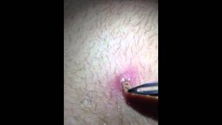 Insane Ingrown Hair