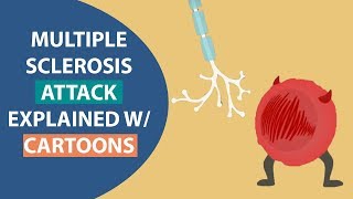 A Multiple Sclerosis Attack | What Actually Happens Inside The Body