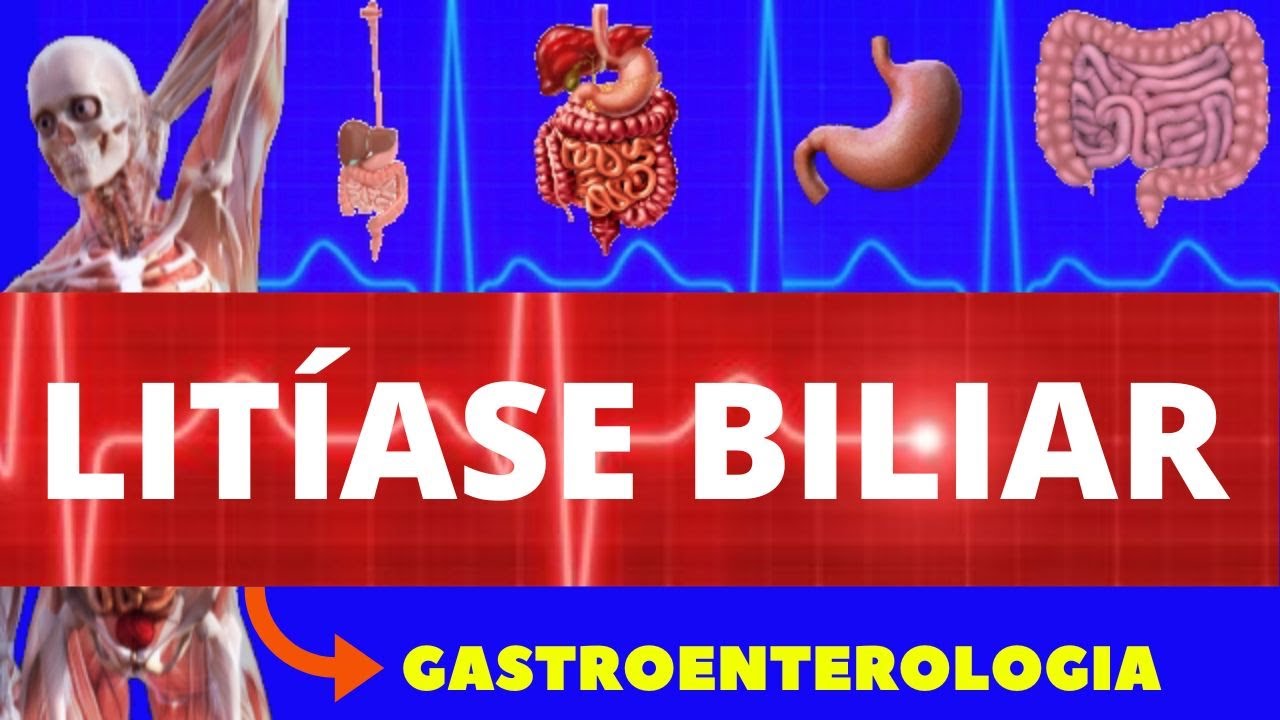 LITÍASE BILIAR (PEDRA NA VESÍCULA) CAUSAS, SINTOMAS, DIAGNÓSTICO E TRATAMENTO LITÍASE BILIAR (PEDRA NA VESÍCULA) CAUSAS, SINTOMAS, DIAGNÓSTICO E TRATAMENTO