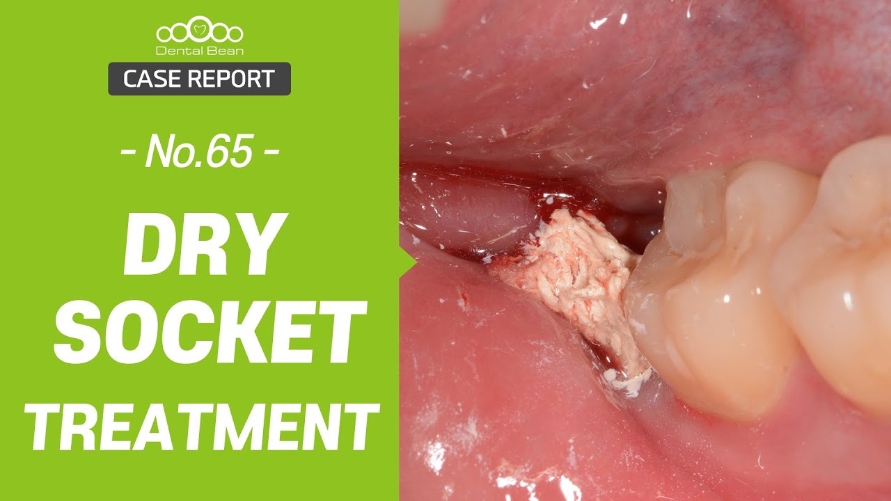 MULTI_SUB] Dry socket treatment (hands_on, Surgery) - [Dr. Cho