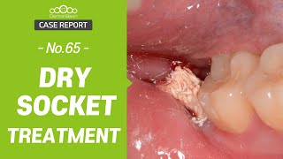 Dry Socket Treatment  Video  MEDtube.net