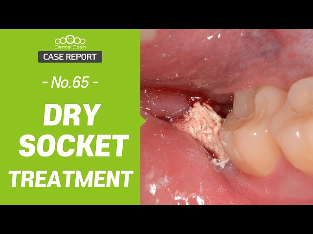 does dry socket dressing fall out Align Dental Care