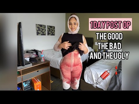 BBL 1 Day Post Op Recovery | BBL the Good, the Bad and the Ugly | 305 plastic Surgery | Dr.William