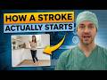 What a Stroke Looks Like the Day Before It Hits — Know This to Protect Yourself