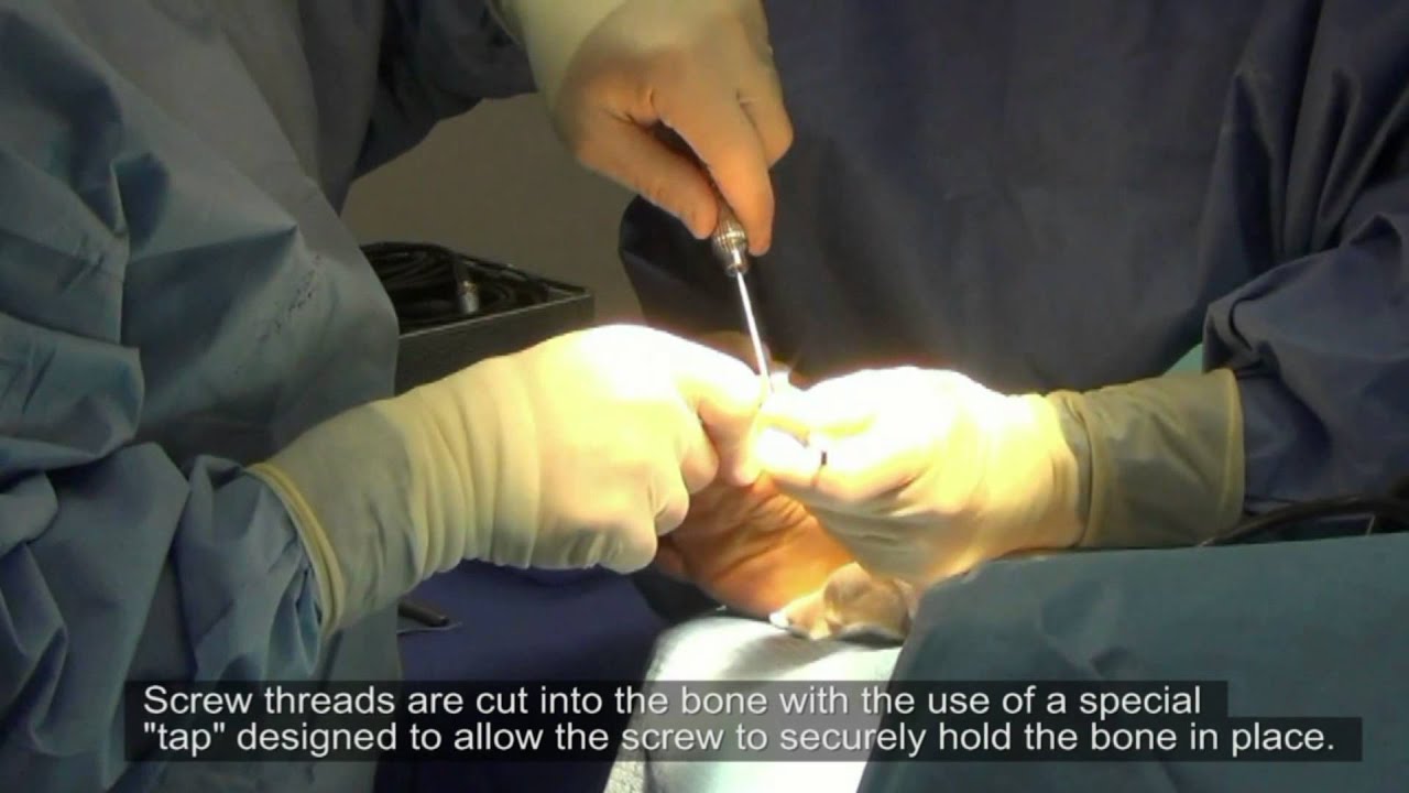 San Diego Bunion Surgery YouTube