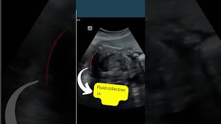 Ultrasound showing boy baby ? | But there is a problem |Large fetal hydrothorax