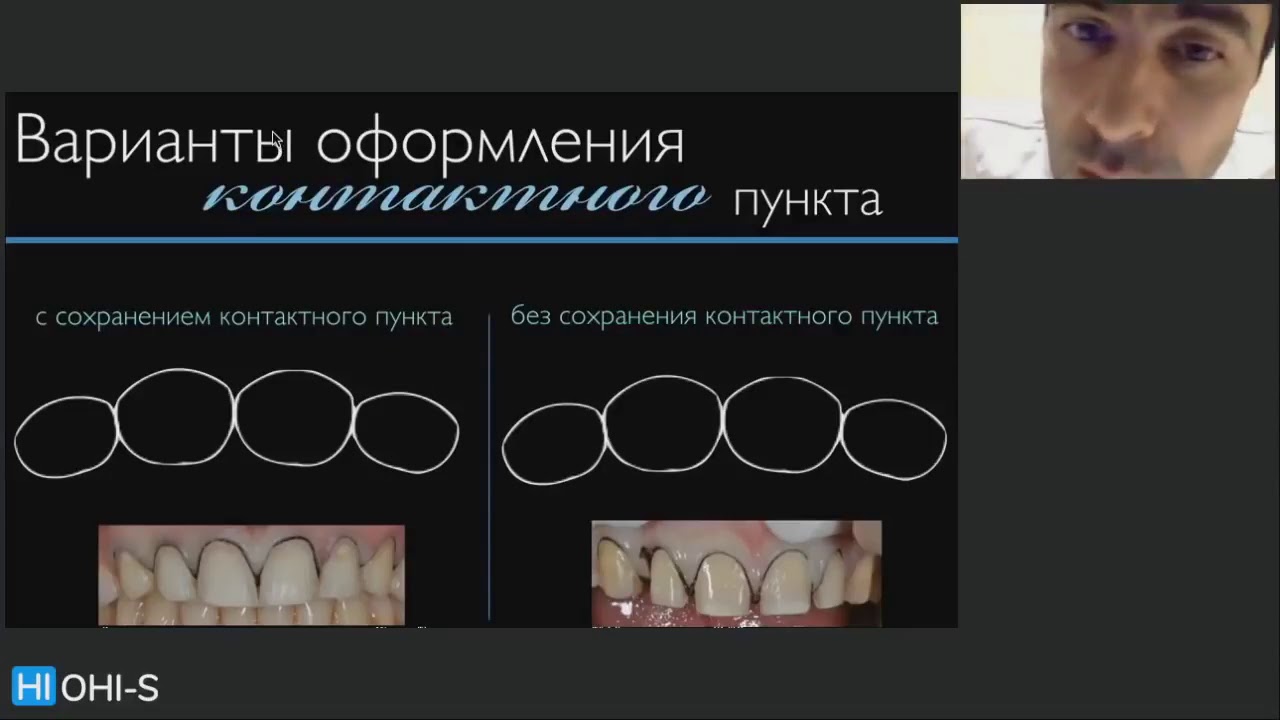 Керамические виниры. Препарирование и снятие оттиска . - YouTube