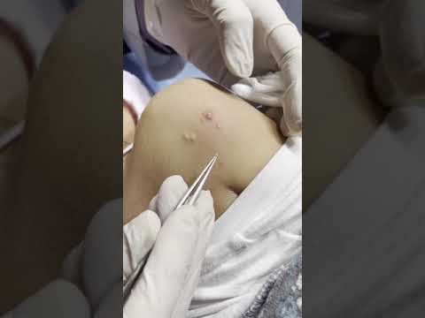 Video: Molluscum Contagiosum - Vzroki, Simptomi In Zdravljenje