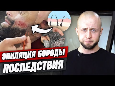 Нельзя вырывать волосы на бороде таким способом! / Какую эпиляцию волос на бороде выбрать?