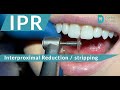 Ipr  interproximal reduction  stripping