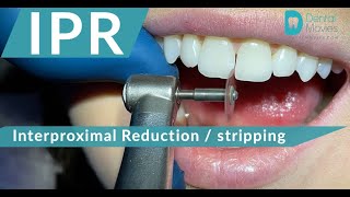 IPR 🪚🦷 Interproximal Reduction - stripping