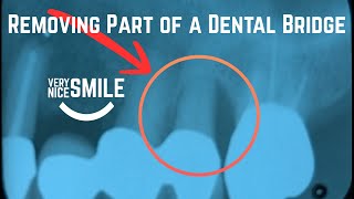 Sectioning A Bridge Tooth | Dental Extraction Technique