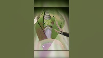 Total Thyroidectomy 3d animation #thyroidproblems #thyroidsurgery #medical3danimation