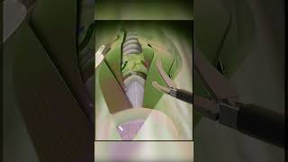 Total Thyroidectomy 3d animation #thyroidproblems #thyroidsurgery #medical3danimation