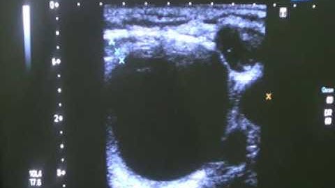 THYROID COLLOIDAL CYST