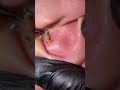 Tag black head