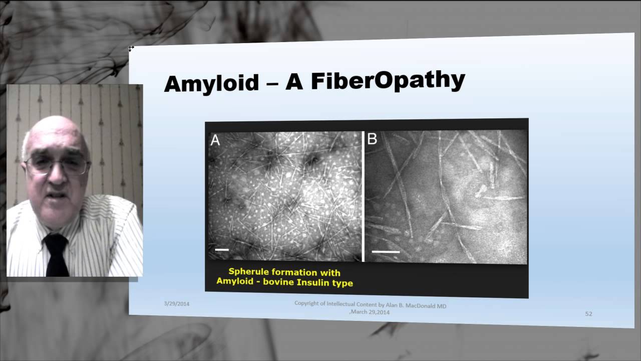 Fiberopathy Lecture by Alan B. MacDonald MD March 30 2014
