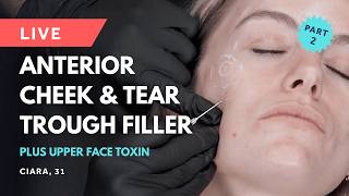LIVE Tear Troughs + Cheek Filler + Upper Face Toxin 💎 Pre-Wedding Full Face Filler Case Study Part 2