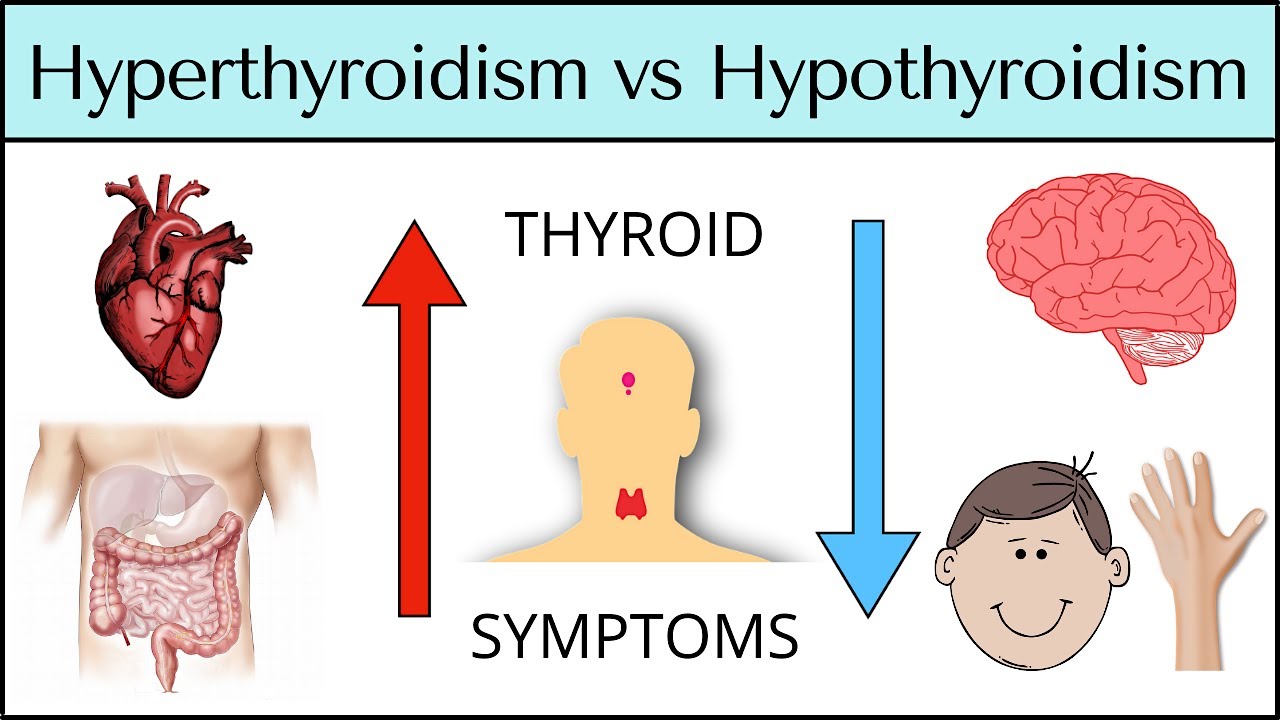 Hyperthyroidism Vs Hypothyroidism Symptoms MADE EASY Thyroid Explained YouTube