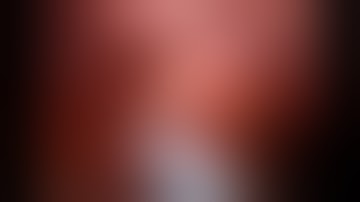 Robotic Chole, trifurcated ducts, FireFly