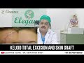 Keloid total excision and skin graft by dr ashutosh shah elegance clinic surat new delhi india