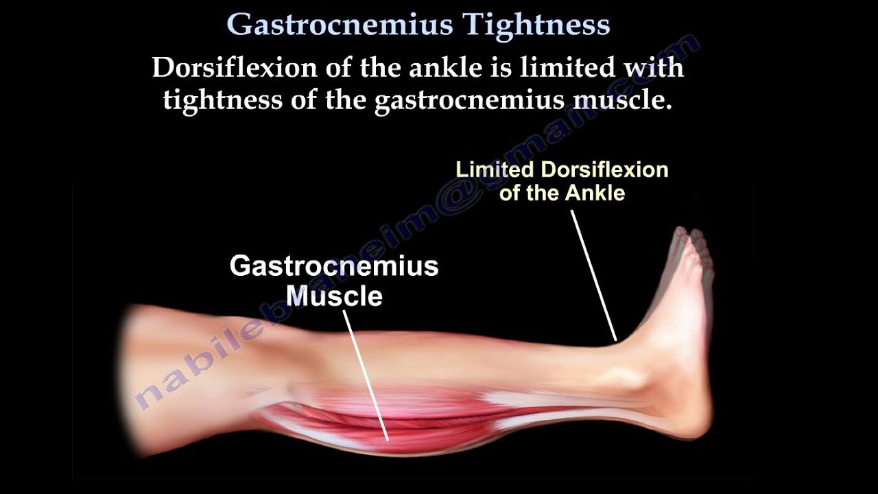 Isolated gastrocnemius tightness: impact on foot diseases