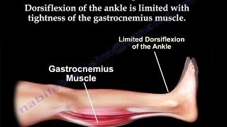 Gastrocnemius Tightness - Everything You Need To Know - Dr. Nabil Ebraheim