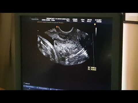 Video: 3 formas de prolongar un embarazo con un cuello uterino incompetente