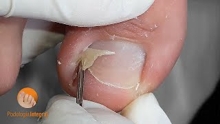 Ingrown toenail & granuloma [Podología Integral]