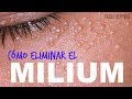 Granitos en los ojos? CÓMO ELIMINAR EL MILIUM!?