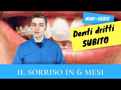 Video: Che Cos'è Il Copricapo Ortodontico E Come Aiuta A Raddrizzare I Denti?