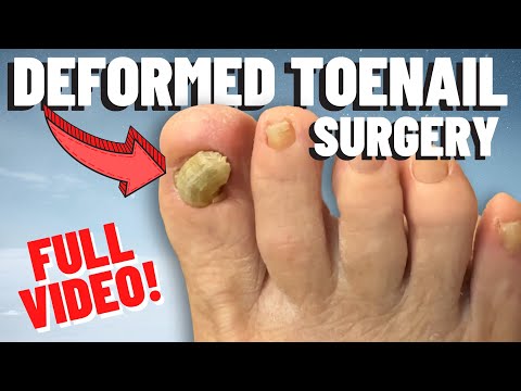 Removing a toenail that is permanently deformed! | Dr. Nick Campitelli