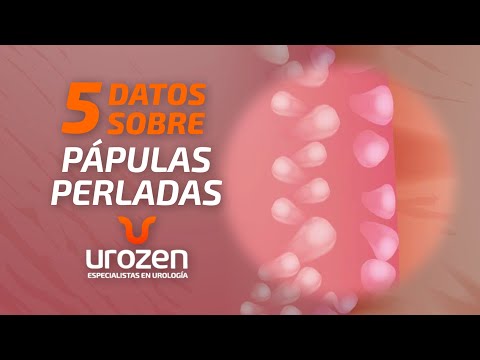 5 Cosas que debes saber sobre Pápulas Perladas