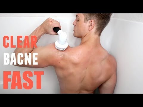 How to Clear Up Back Acne, Dark Spots FAST (Perfect Shower Routine)