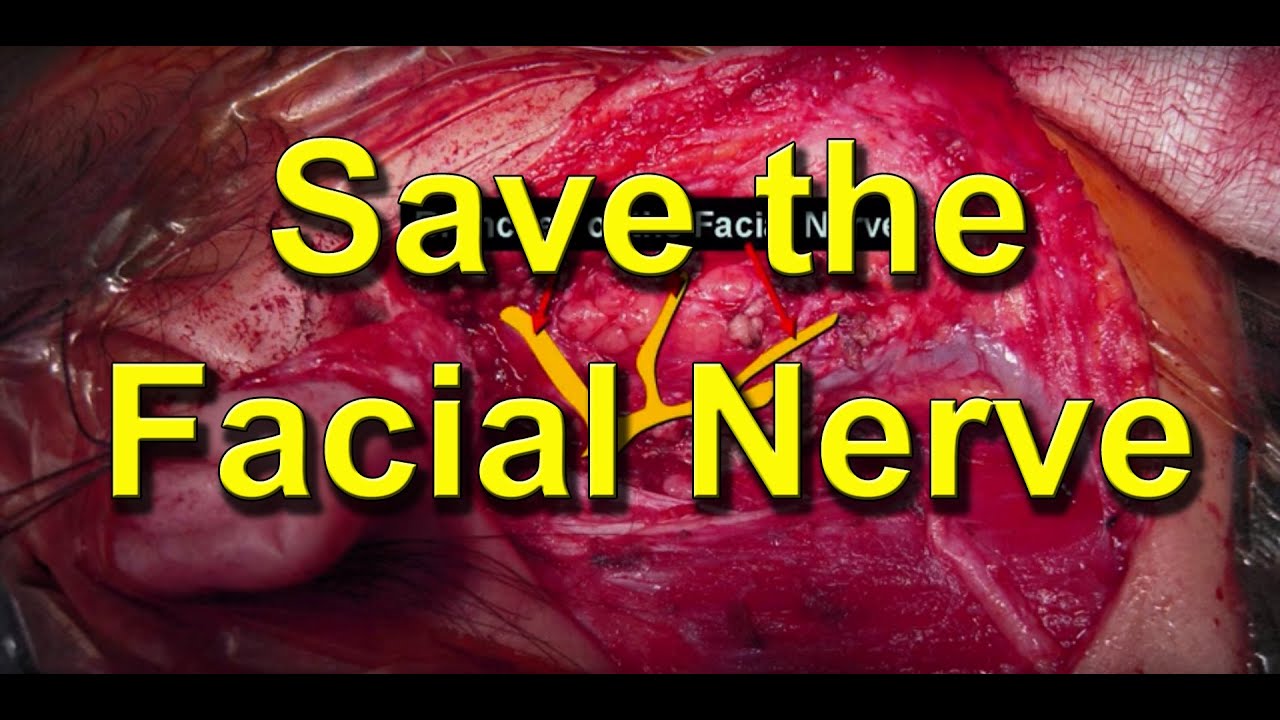 How To Save The Facial Nerve During Parotid Salivary Gland Cancer