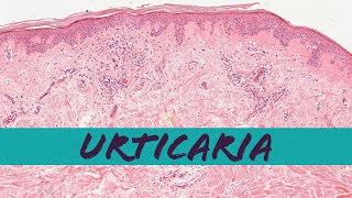 Urticaria (Hives) under the microscope (pathology dermpath dermatology USMLE)