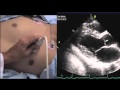 Echocardiography How to Find a Window.mov