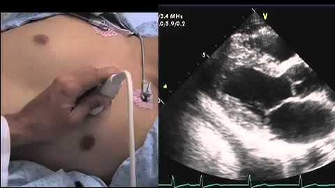 Echocardiography How to Find a Window.mov