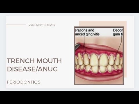TRENCH MOUTH DISEASE/ANUG