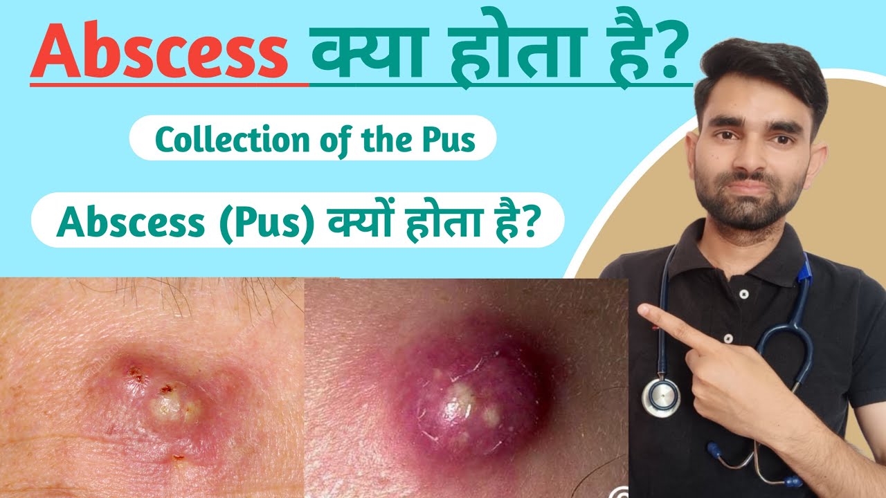Abscess In Hindi Abscess Kya Hai Abscess Ka Matlab Kya Hota Hai 
