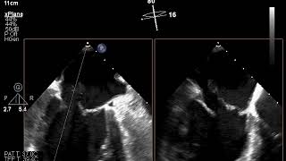 Flail papillary muscle TEE
