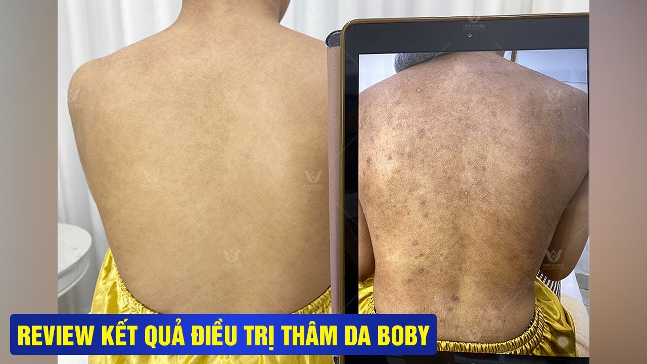 Da Body Thâm Sần Lâu Năm → Sáng Khỏe, Mịn Màng Chỉ Sau 60 Phút!
