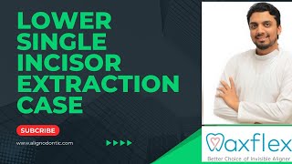 Clinical Case # 3 | Lower single incisor extraction case treated with Alignodontic Clear Aligners