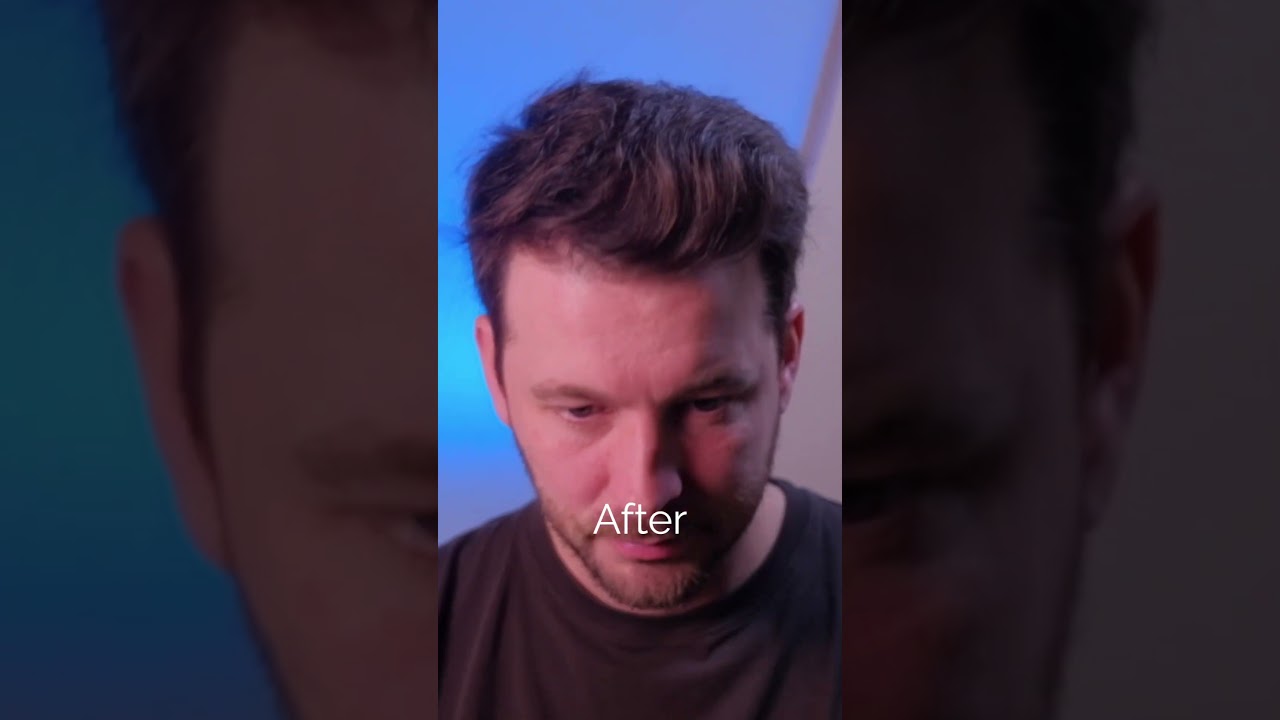 Crown Balding SOLUTION! Jae Pak MD Medical 