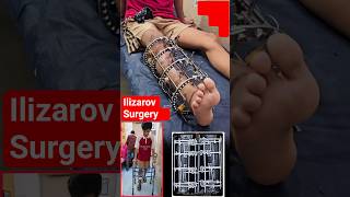 Tibia bone fracture ke Non-union case Treatment by Ilizarov Surgery in Deshwar Hospital