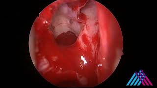 Functional Endoscopic Sinus Surgery (FESS) for sinusitis