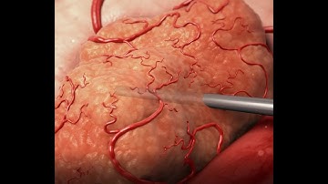 New radiotherapy technology to treat cancer directly to the cancerous cells - Alpha Tau