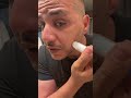 Beats hair transplant #hairtok