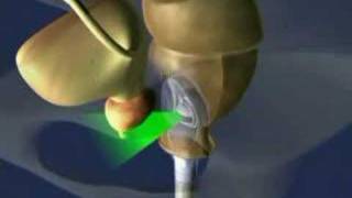 www.cmedtravel.com - Ablatherm HIFU for Prostate Cancer Treatment by EDAP
